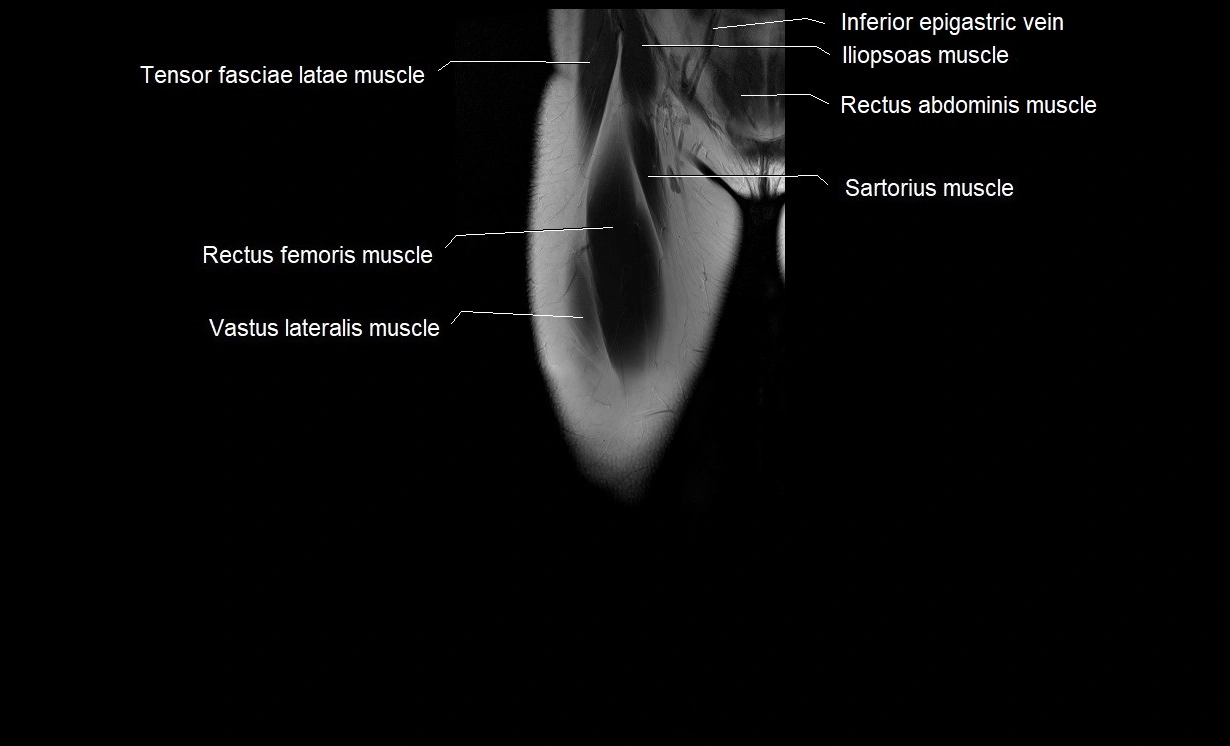 MRI thigh coronal cross sectional anatomy image 3.webp